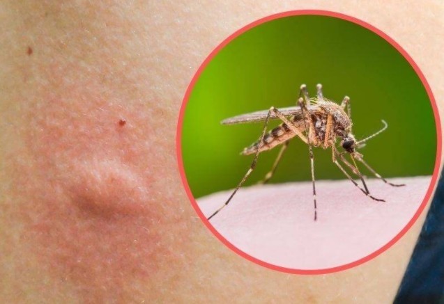 Покусали комары ребенка, взрослого, что делать? Первая помощь при укусе комара. Народные средства от укусов.