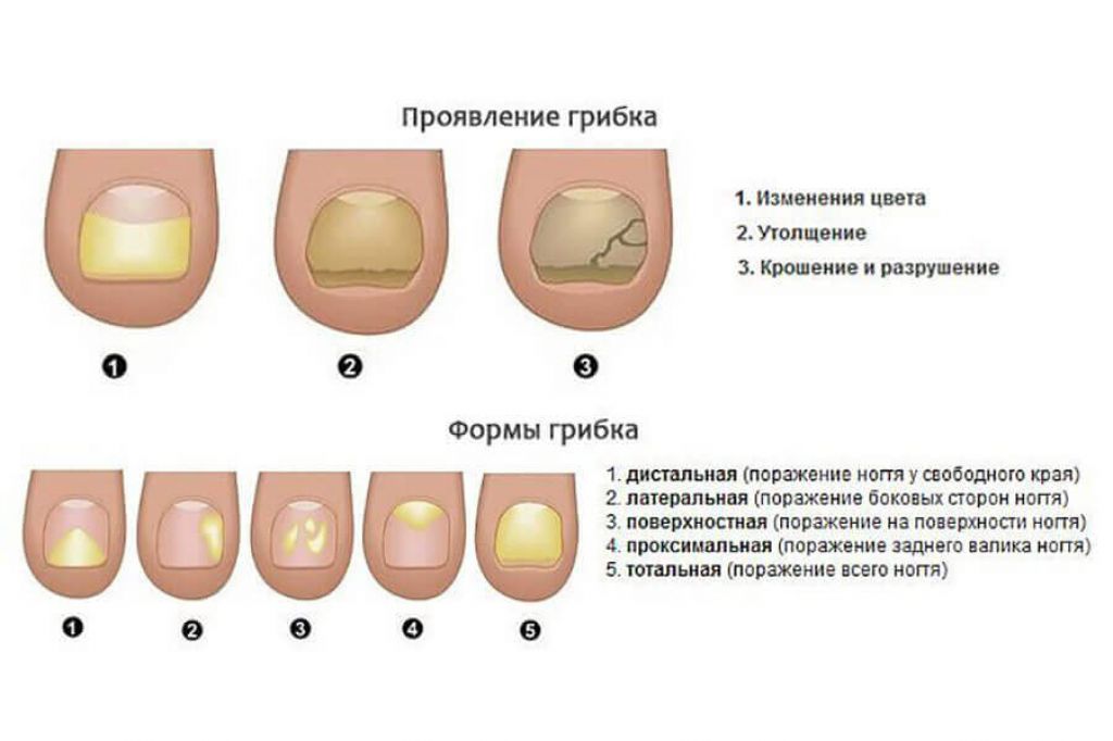 Первые признаки грибка ногтей